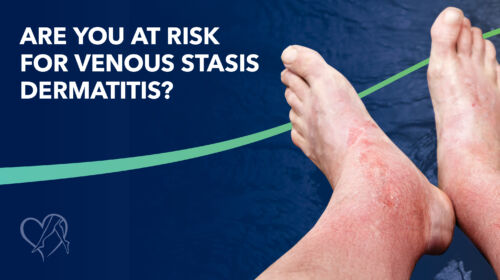 Blog Image Are Youat Riskfor Venous Stasis Dermatitis Thumbnail