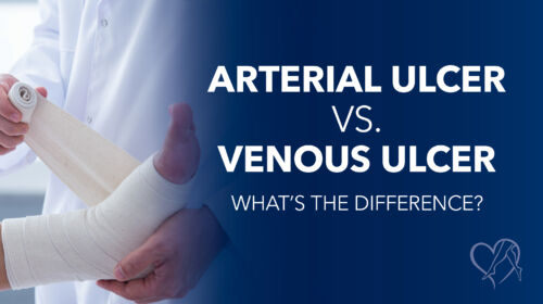 Blog Image Arterial vs Venous Ulcer Thumbnail