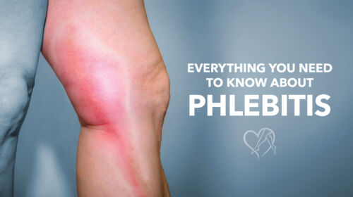 Blog Image Everything You Needto Know About Phlebitis Thumbnail