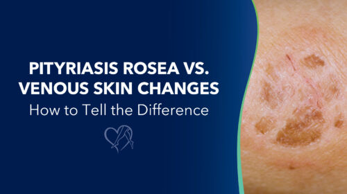 Blog Image Pityriasis Rosea Thumbnail