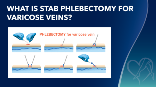 Blog Image Pt Story Whatis Stab Phlebectomy For Varicose Veins Thumbnail