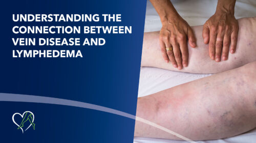 Blog Image Understanding the Connection Between Vein Disease and Lymphedema Thumbnail