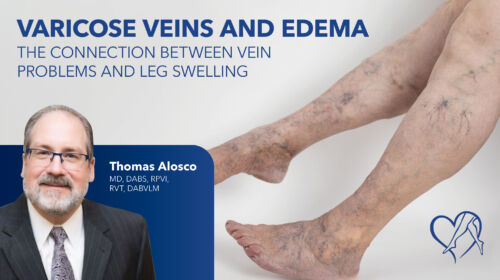 Blog Image Varicose Veins And Edema Thumbnail