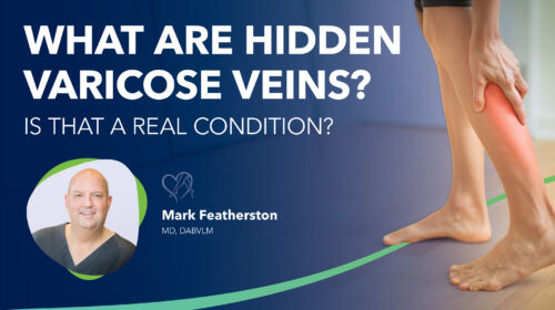 Blog Image What Are Hidden Varicose Veins Thumbnail