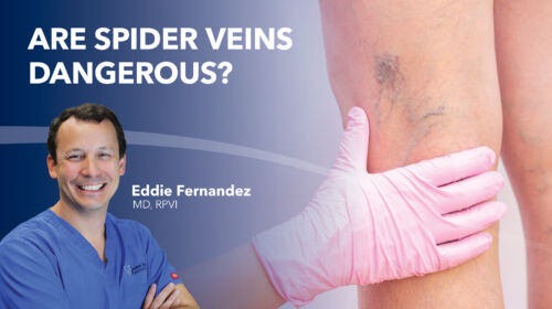 Blog Are Spider Veins Dangerous Thumbnail