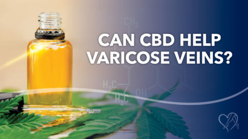 Blog Can CBD Help Varicose Veins Thumbnail