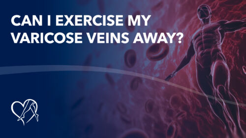 Blog Can I Exercise My Varicose Veins Away Thumbnail