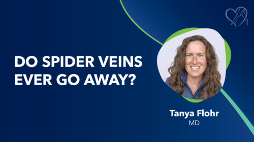 Blog Do Spider Veins Ever Go Away Thumbnail