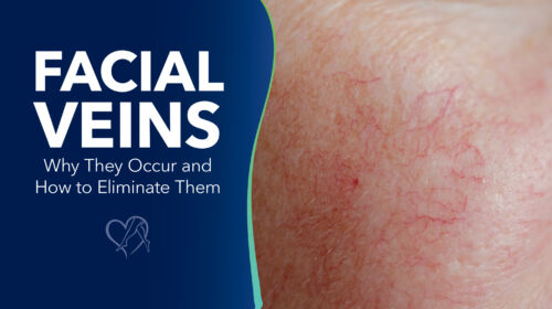Blog Facial Veins Thumbnail