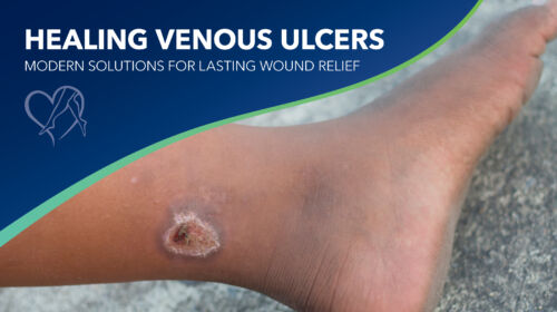 Blog Healing Venous Ulcers Thumbnail