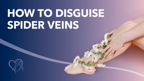 Blog How To Disguise Spider Veins Thumbnail