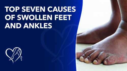 Blog Top Seven Causesof Swollen Feetand Ankles Thumbnail