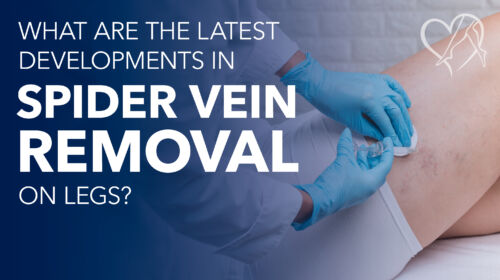 Blog What Arethe Latest Developmentsin Spider Vein Removalon Legs Thumbnail
