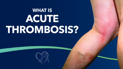 Blog What Is Acute Thrombosis Thumbnail
