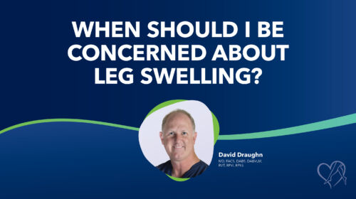 Blog When Should I Be Concerned With Leg Swelling Thumbnail