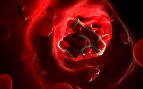 Blood Clot in the Foot Symptoms and Treatment 1