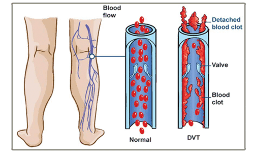 Deep vein thrombosis
