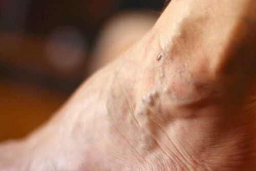 Superficial vein thrombosis