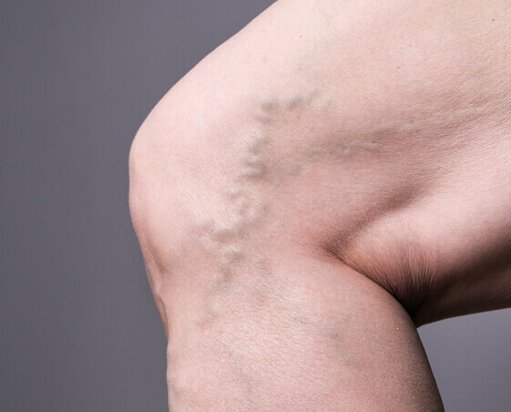 Varicose veins image