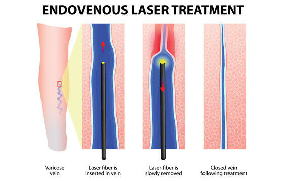 Laser