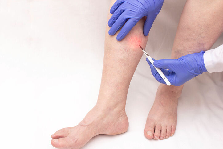 Vein treatment leg