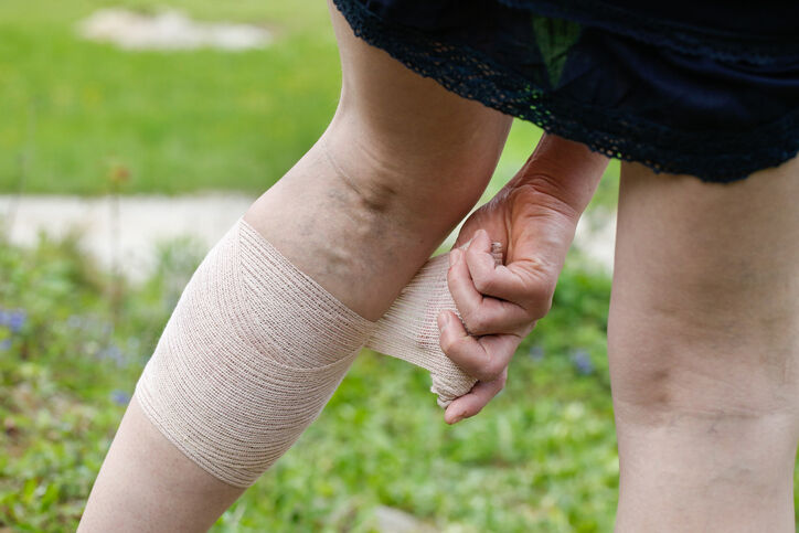 Woman with varicose veins applying compression