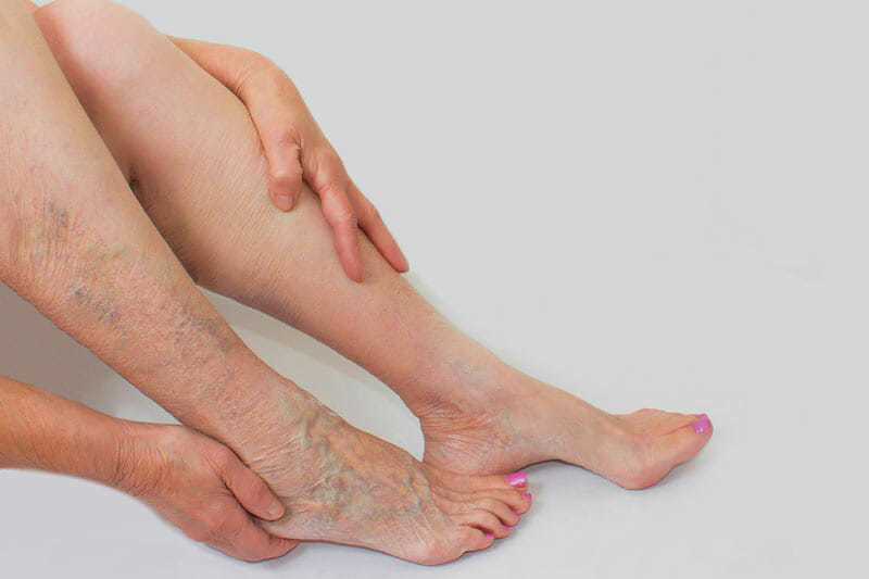 tratamiento de piernas sin varices