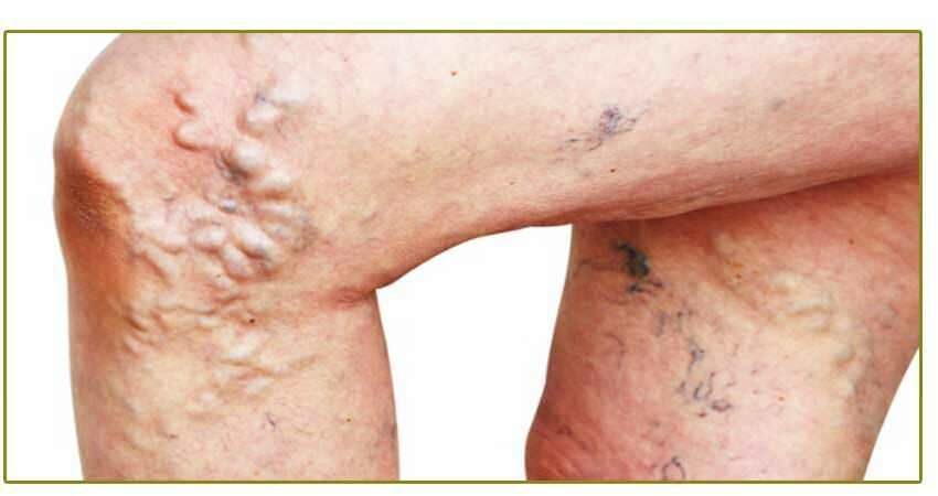 Varicose veins