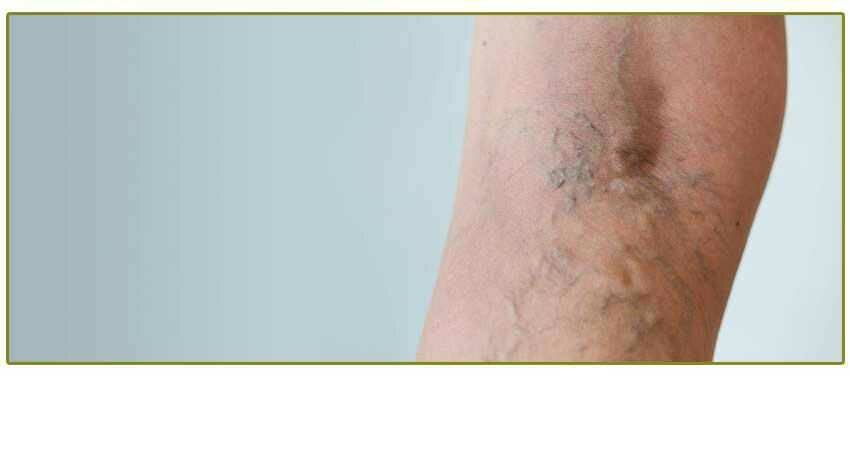 Vein disease