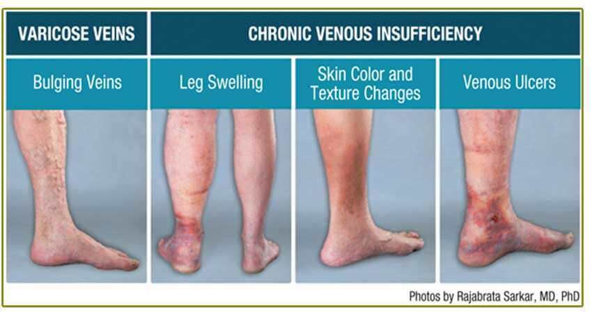 Chronic Venous Insufficiency Albuquerque