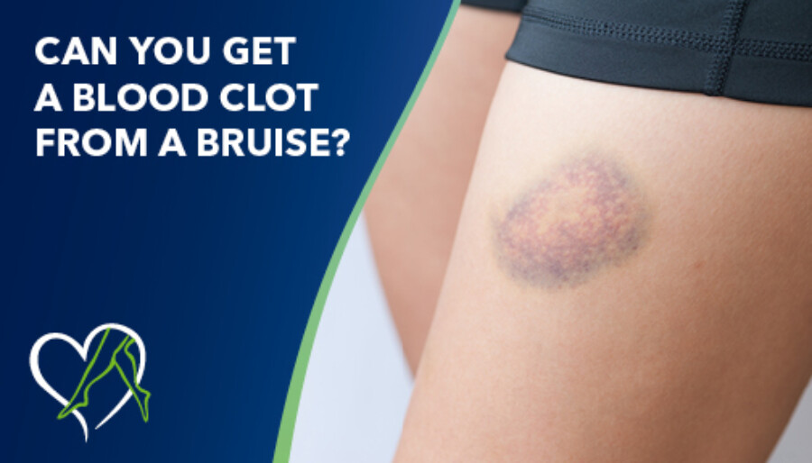 Blog Image Can You Get Blood Clot From Bruise