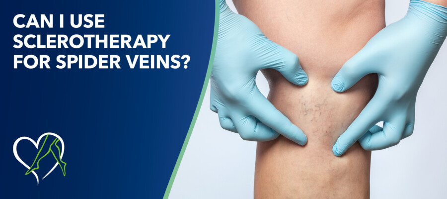 Blog Can I Use Sclerotherapy For Spider Veins
