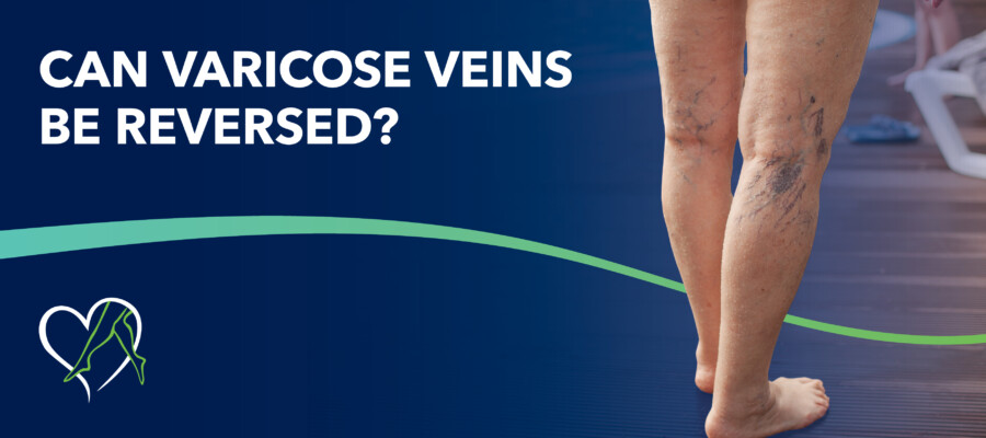 Blog Can Varicose Veins Be Reversed