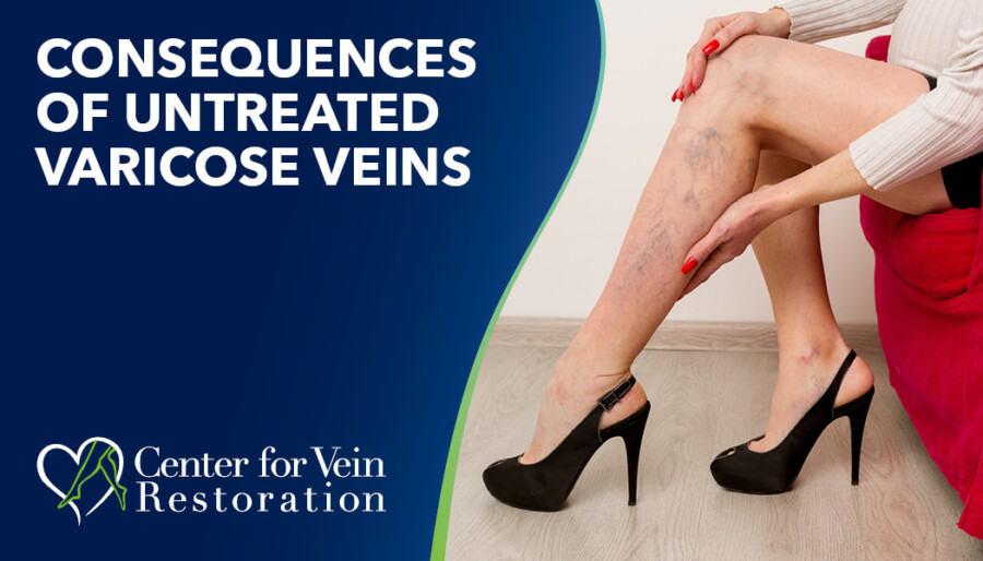 Blog Consequences Of Untreated Varicose Veins