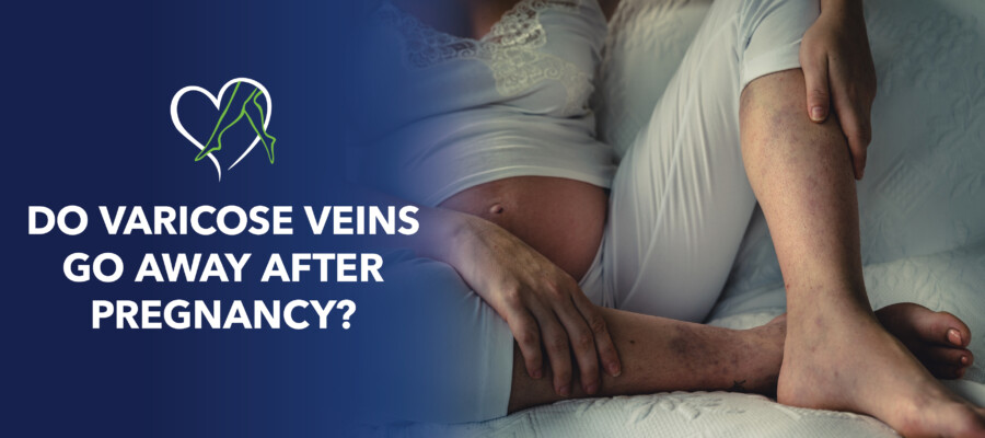 Blog Do Varicose Veins Go Away After Pregnancy