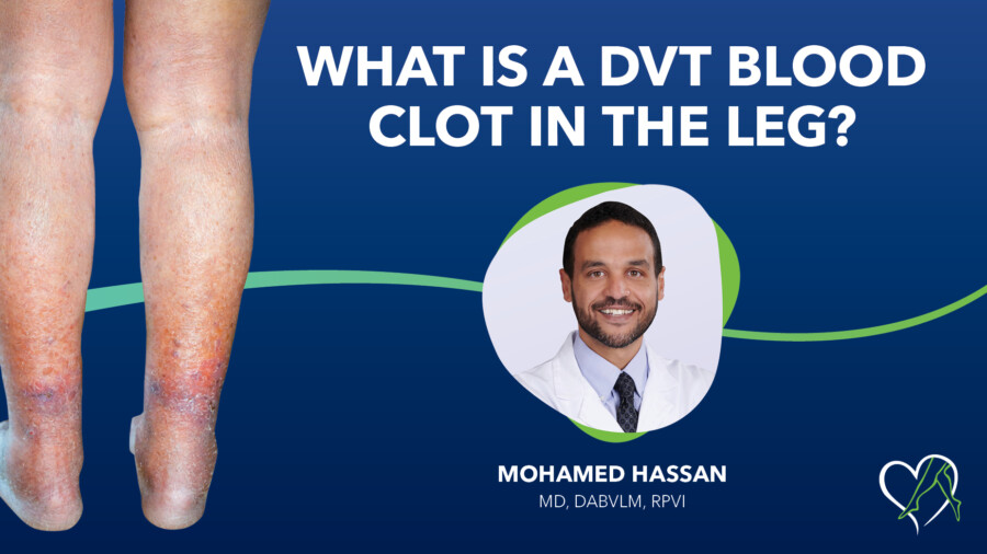 Blog Dr Hassasn What Is a DVT Blood Clot