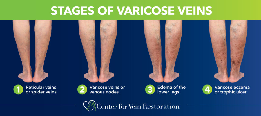 Blog Stages Of Varicose Veins