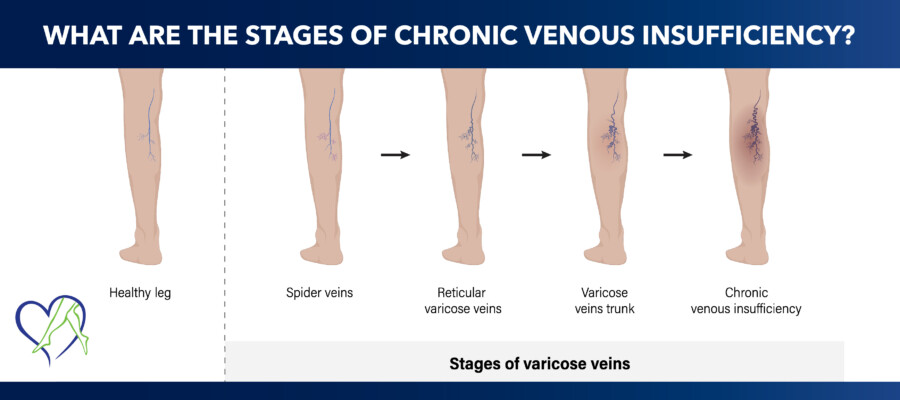 What are the stages of chronic venous insufficiency?