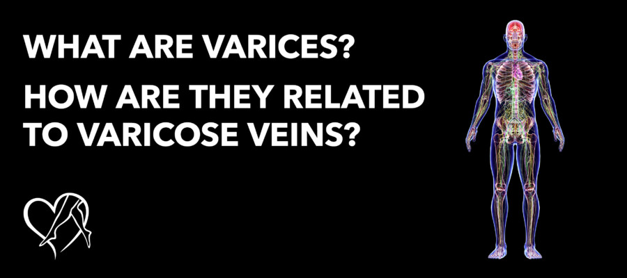 Blog What Are Varices