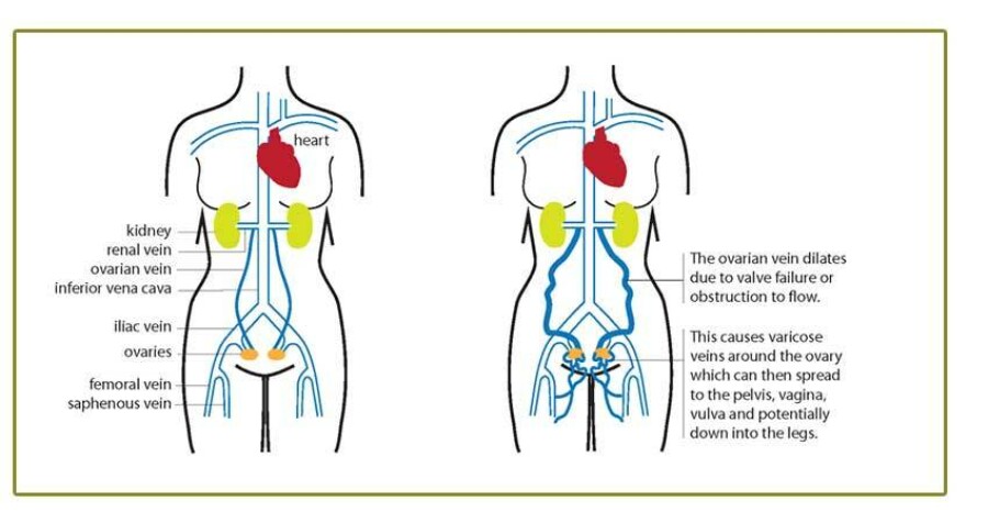 Pelvic Venous Syndromes