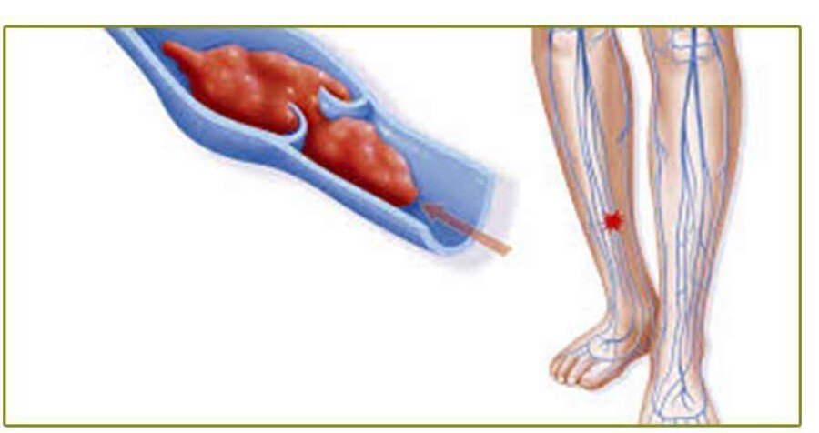 Post Thrombotic Syndrome