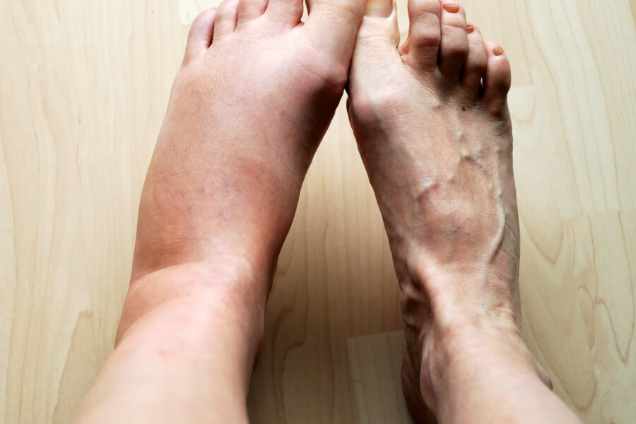 Signs of Disease Your Feet Can Reveal