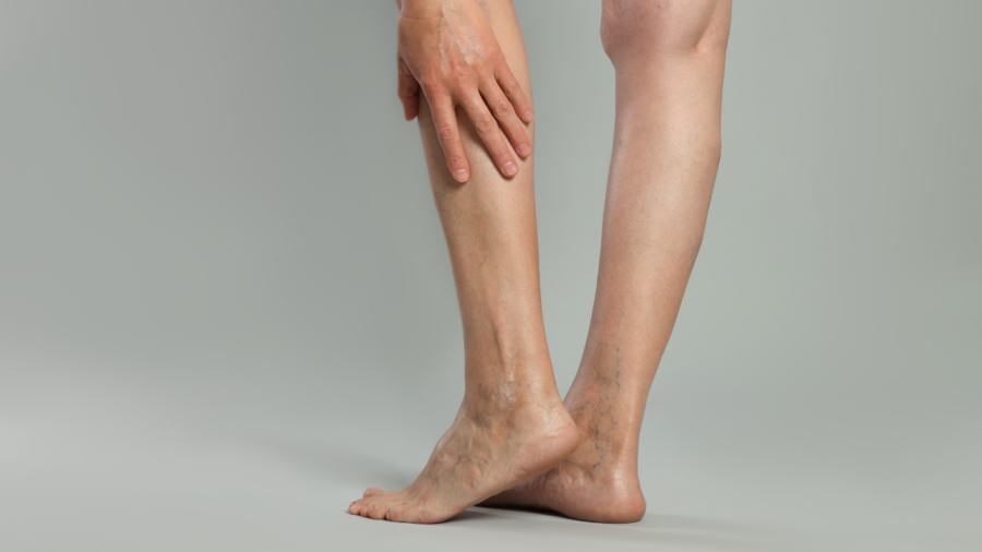 Varicose Veins and Blood Clots Whats the Connection