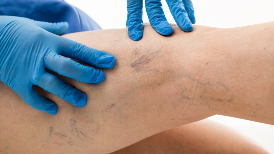 Visual signs of Spider Veins