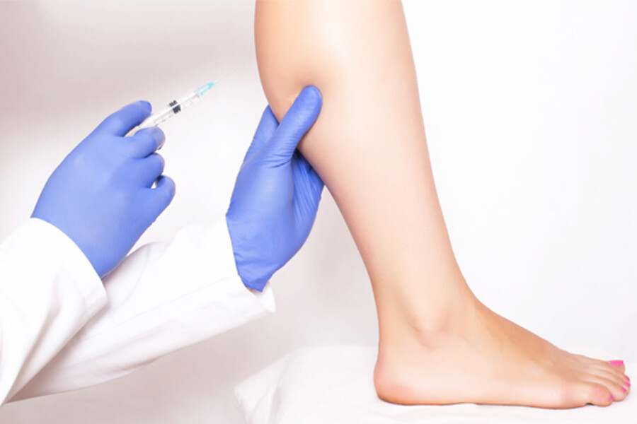 Can i use botox to get rid of varicose veins