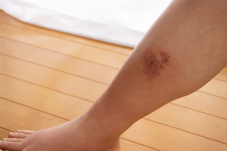 Cellulitis on leg