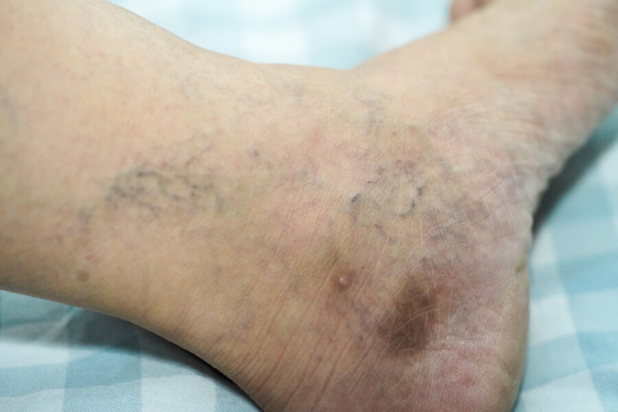 Center Vein Restoration | ¿Cuáles son esas manchas marrones en piernas?
