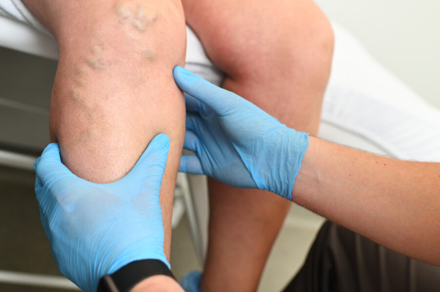 Hlebologist examines a patient with varicose veins
