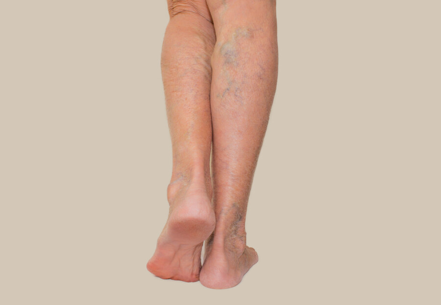 Varicose veins - Venous diseases - Compression - Indications