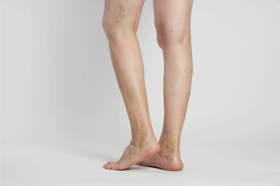 Can Chronic Venous Insufficiency Be Cured